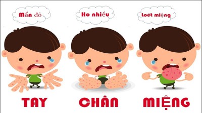 Phòng bệnh tay chân miệng  cho trẻ