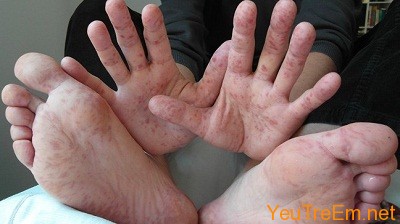 Phòng bệnh tay chân miệng cho trẻ mầm non