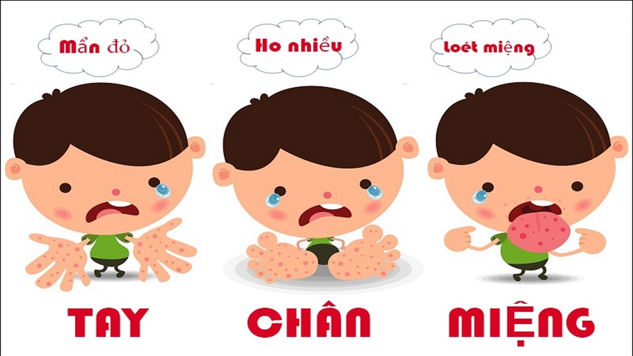 Phòng bệnh tay chân miệng  cho trẻ
